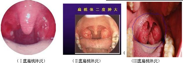 扁桃体肿大分级是什么？